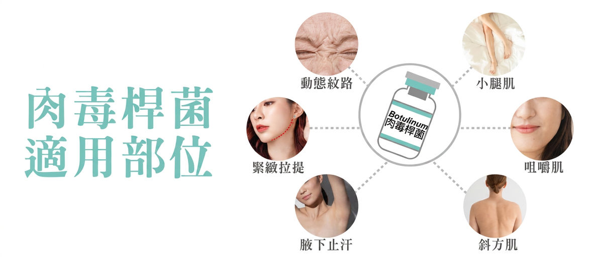 肉毒桿菌適用部位:動態紋路、緊緻拉提、腋下止汗、小腿肌、咀嚼肌、斜方肌