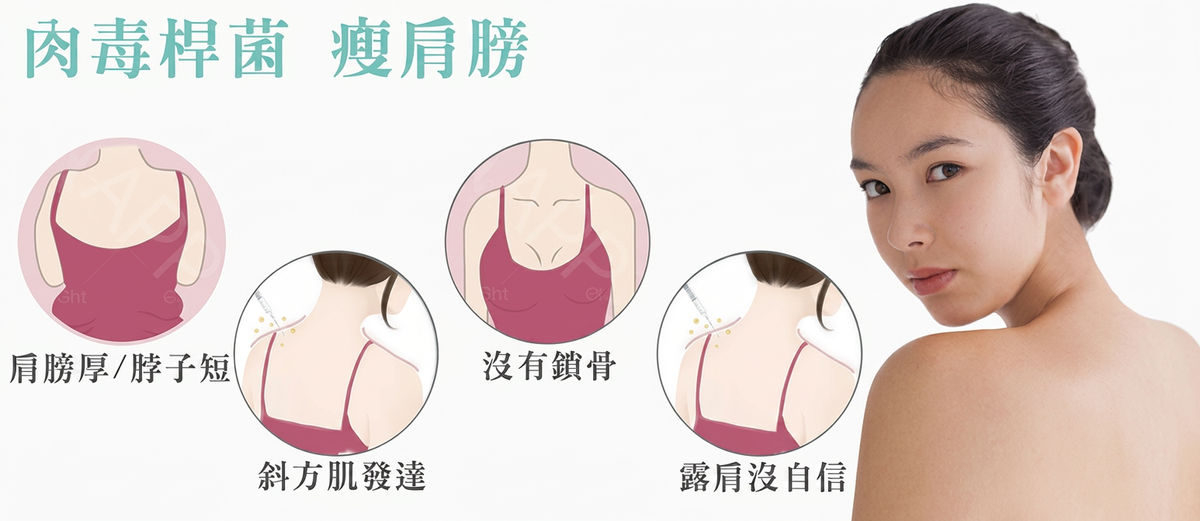 肉毒桿菌瘦肩膀:肩膀厚脖子短、斜方肌發達