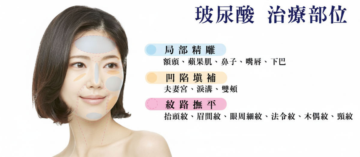 玻尿酸治療部位:局部精雕、凹陷填補、紋路撫平