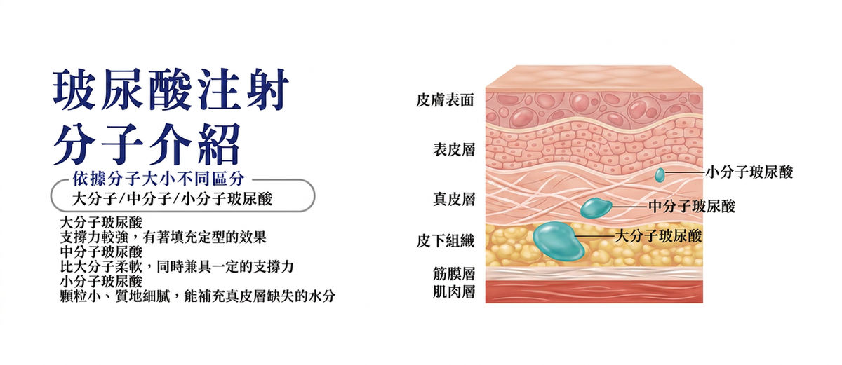 玻尿酸分子介紹:大分子、中分子、小分子注射層次
