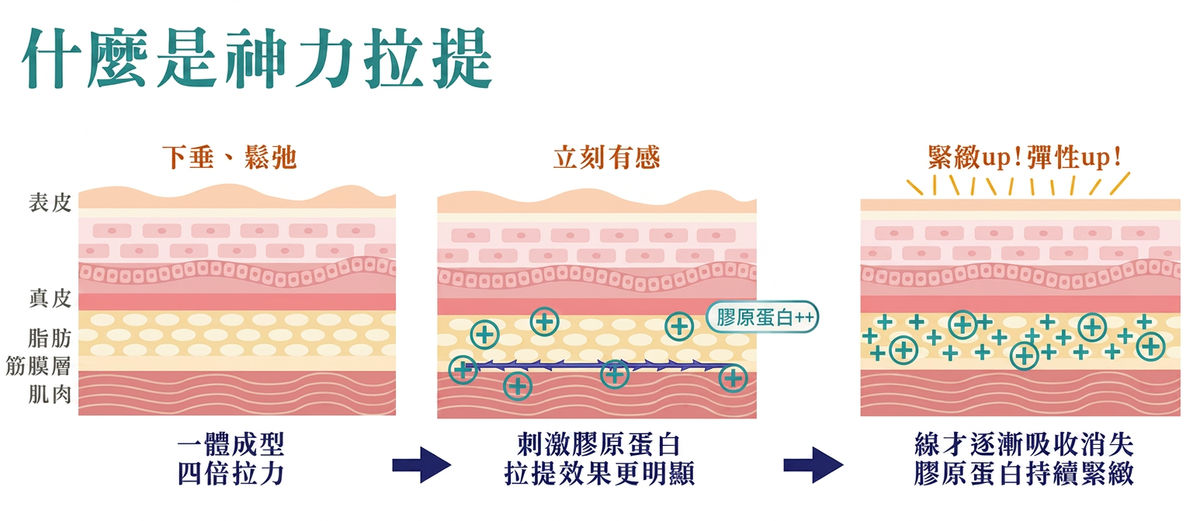 什麼是神力拉提:一體成型四倍拉力、刺激膠原蛋白、線材逐漸吸收後持續緊緻