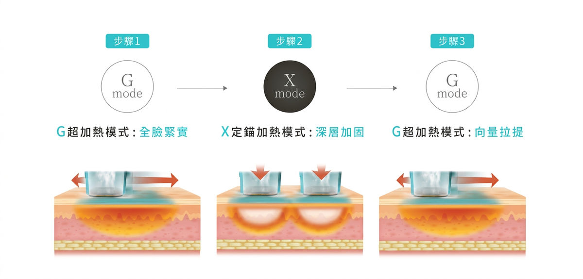 超玩美X電波療程說明圖 3