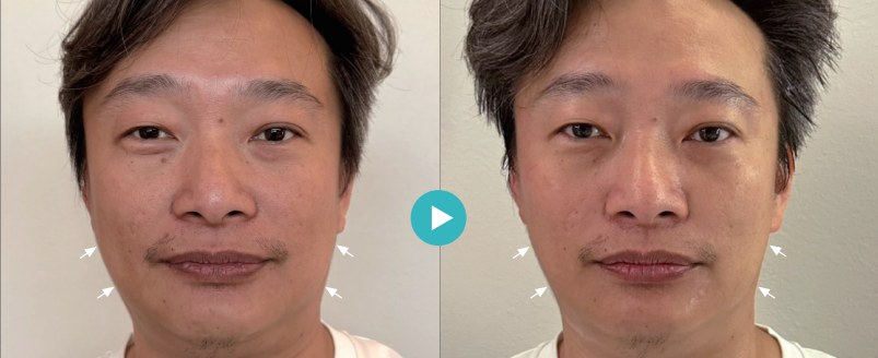 超玩美X電波術前術後案例:40 歲