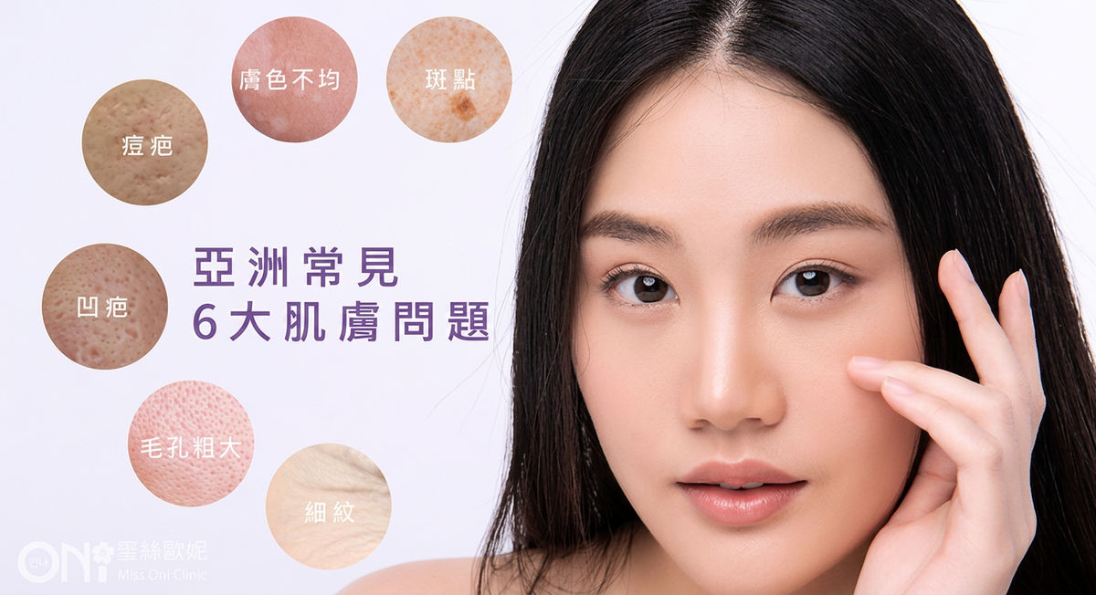 亞洲常見 6 大肌膚問題:痘疤、膚色不均、斑點、凹疤、毛孔粗大、細紋