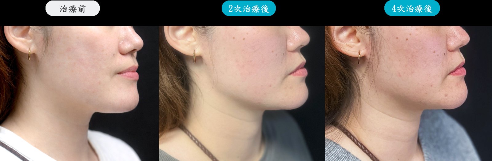 冰挺超微波療程說明圖 2