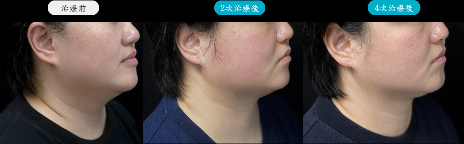 冰挺超微波療程說明圖 3