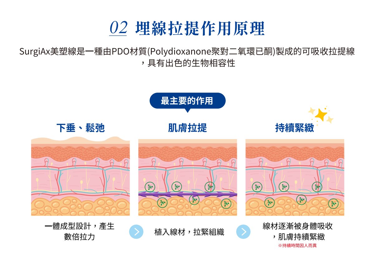 埋線拉提作用原理:下垂鬆弛、植入線材拉緊組織、線材被吸收後持續緊緻