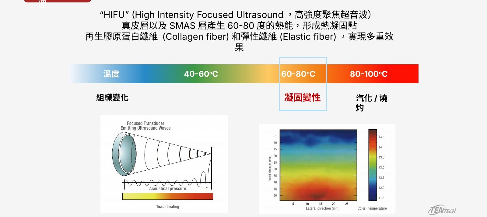 十倍雙線音波療程說明圖 2