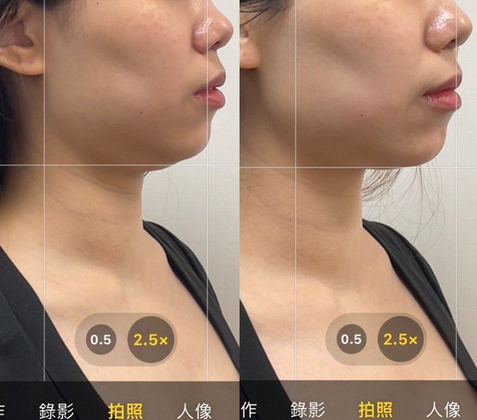 十倍雙線音波術前術後案例:25 歲 女性