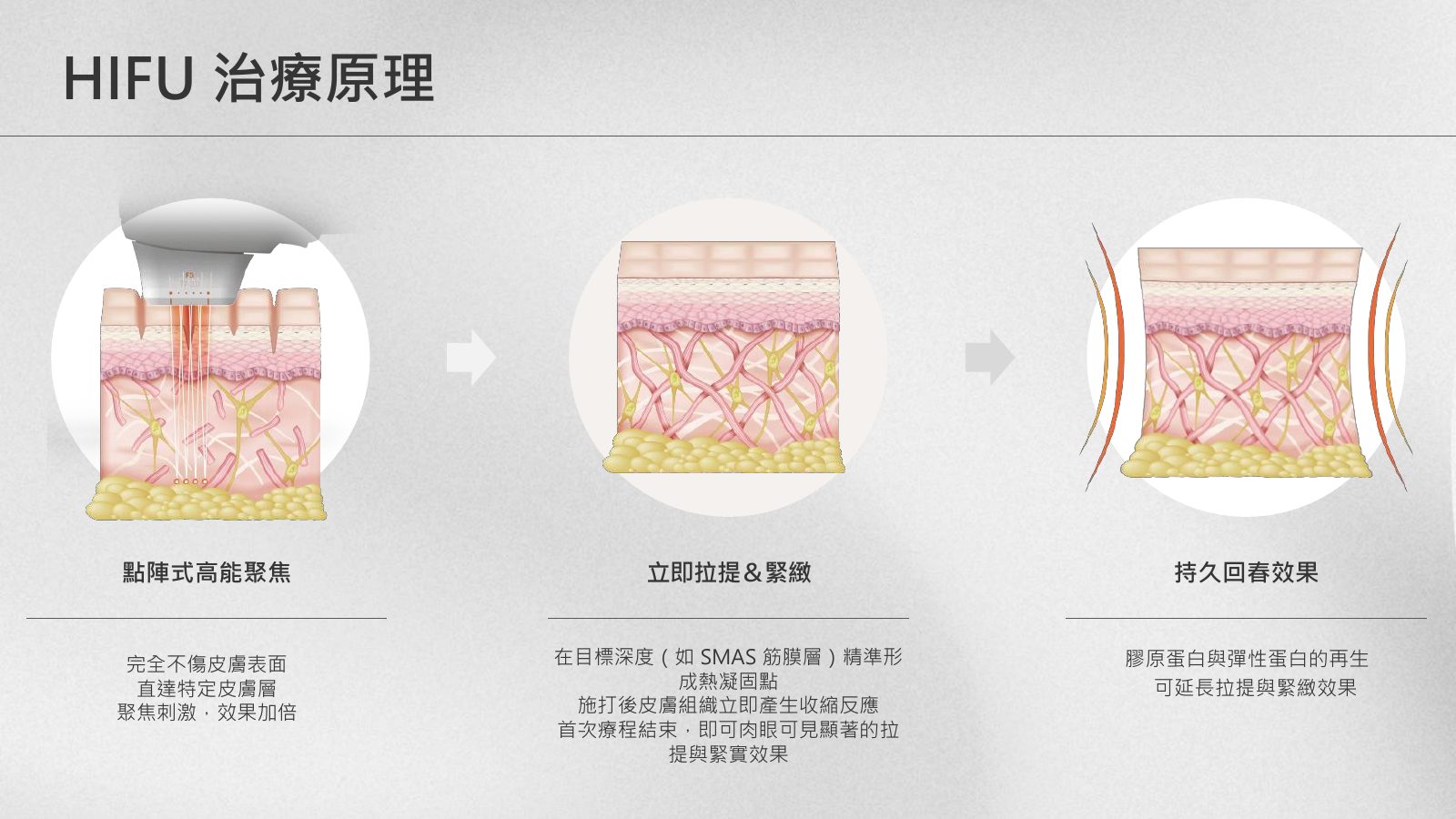 鈦玩美音波療程說明圖 2