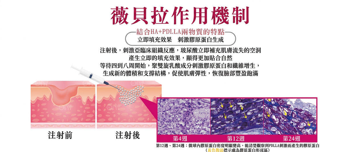 薇貝拉作用機制:注射前、注射後與第 4、12、24 週膠原蛋白增生
